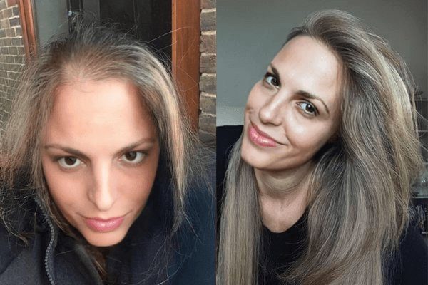 Sarah antes e depois do tratamento