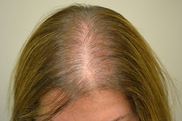 Alopecia feminina — rarefação no topo da cabeça