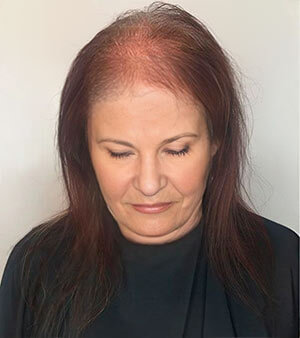 Queda severa de cabelo